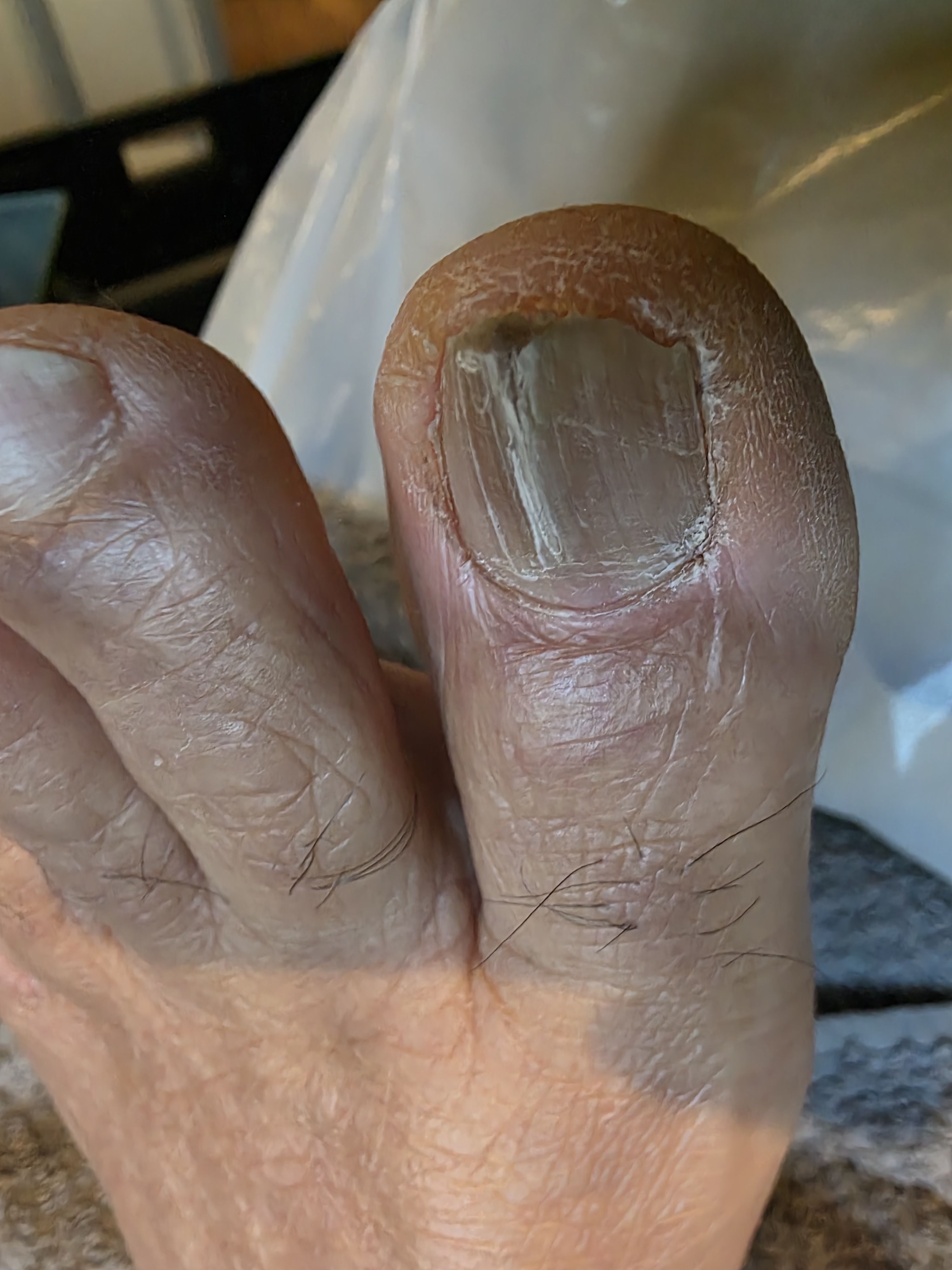 Before foot treatment