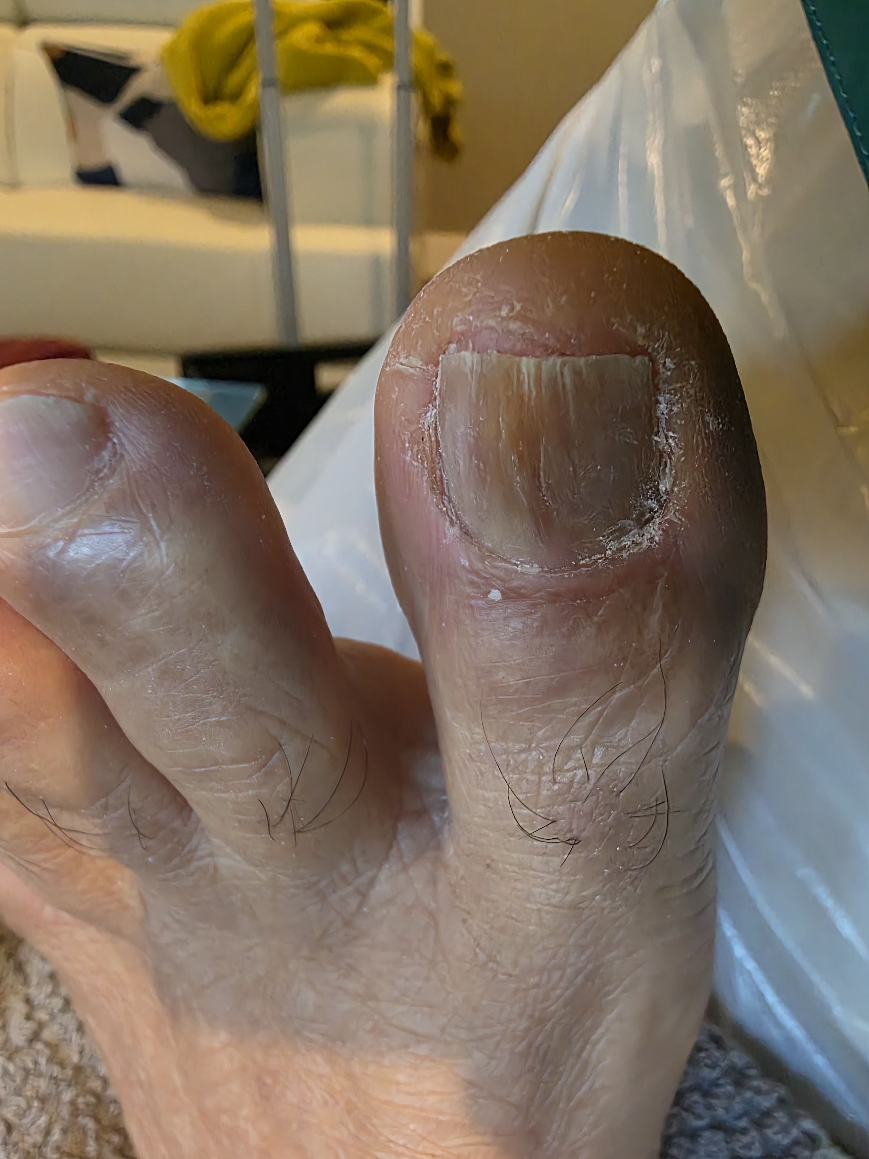 After foot treatment